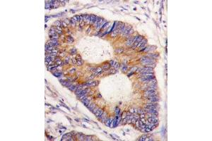 Formalin-fixed and paraffin-embedded human colon carcinoma tissue reacted with FXN antibody (Center) (ABIN390378 and ABIN2840780) , which was peroxidase-conjugated to the secondary antibody, followed by DAB staining. (Frataxin antibody  (AA 72-102))