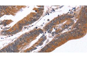 Immunohistochemistry of paraffin-embedded Human colon cancer tissue using GREB1 Polyclonal Antibody at dilution 1:40 (GREB1 antibody)