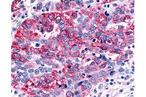 Anti-GABABR1 / GABBR1 antibody IHC of human Ovary, Carcinoma. (GABBR1 antibody  (N-Term))
