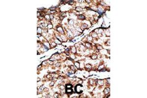Formalin-fixed and paraffin-embedded human cancer tissue reacted with DKKL1 polyclonal antibody  , which was peroxidase-conjugated to the secondary antibody, followed by DAB staining. (DKK1 antibody  (C-Term))