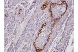 IHC-P Image Immunohistochemical analysis of paraffin-embedded Ca922 xenograft, using CROT, antibody at 1:100 dilution. (CROT antibody)