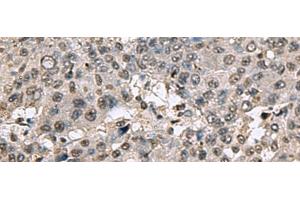 Immunohistochemistry of paraffin-embedded Human liver cancer tissue using TMX3 Polyclonal Antibody at dilution of 1:70(x200)