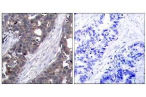 Immunohistochemical analysis of paraffin-embedded human breast carcinoma tissue using p70 S6 Kinase (Ab-411) antibody (E021261). (RPS6KB1 antibody)