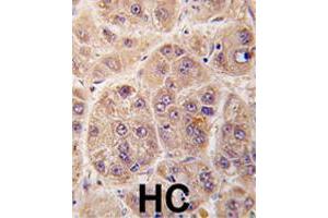 Formalin-fixed and paraffin-embedded human hepatocellular carcinoma reacted with PIM3 polyclonal antibody  , which was peroxidase-conjugated to the secondary antibody, followed by DAB staining. (PIM3 antibody  (C-Term))