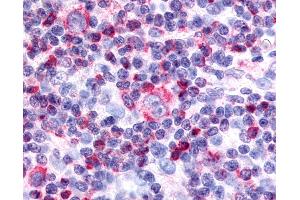 Anti-Nor-1 / NR4A3 antibody IHC of human Lymph Node, Hodgkins Lymphoma. (NR4A3 antibody  (Internal Region))