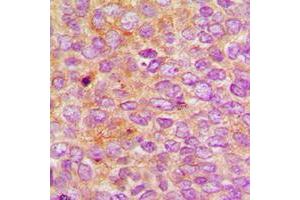 Immunohistochemical analysis of Nephrocystin 5 staining in human breast cancer formalin fixed paraffin embedded tissue section. (IQCB1 antibody  (Center))