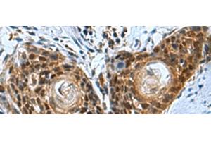 Immunohistochemistry of paraffin-embedded Human esophagus cancer tissue using ITGB1BP1 Polyclonal Antibody at dilution of 1:50(x200) (ITGB1BP1 antibody)