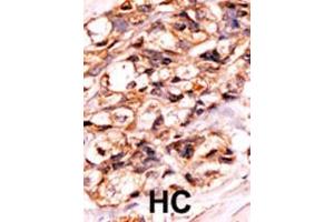 Formalin-fixed and paraffin-embedded human cancer tissue reacted with the primary antibody, which was peroxidase-conjugated to the secondary antibody, followed by AEC staining. (BAD antibody  (pSer118))