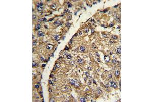 Formalin-fixed and paraffin-embedded human hepatocarcinoma with VTN Antibody (C-term), which was peroxidase-conjugated to the secondary antibody, followed by DAB staining. (Vitronectin antibody  (C-Term))