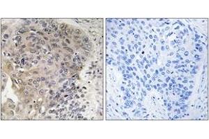 Immunohistochemistry analysis of paraffin-embedded human lung carcinoma, using CBCP3 Antibody. (AGBL3 antibody  (AA 611-660))