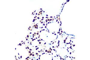 Immunohistochemistry of paraffin-embedded human thyroid cancer using hnRNP U Rabbit mAb (ABIN1679689, ABIN3018741, ABIN3018742 and ABIN7101656) at dilution of 1:100 (40x lens). (HNRNPU antibody)