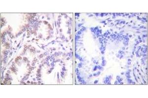 Immunohistochemistry analysis of paraffin-embedded human lung carcinoma tissue, using CDK7 Antibody. (CDK7 antibody  (AA 291-340))