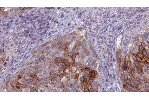 ABIN6275668 at 1/100 staining Human urothelial cancer tissue by IHC-P. (ATP6V1B1 antibody  (Internal Region))