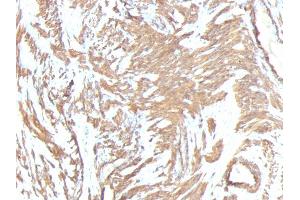 Formalin-fixed, paraffin-embedded human Leiomyosarcoma stained with Smooth Muscle Actin Monoclonal Antibody (1A4 + ACTA2/791). (Smooth Muscle Actin antibody  (N-Term))