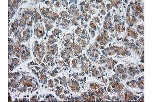 Immunohistochemical staining of paraffin-embedded Carcinoma of liver tissue using anti-CYP1A2 mouse monoclonal antibody. (CYP1A2 antibody)