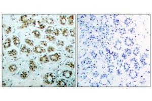 Immunohistochemical analysis of paraffin-embedded human breast carcinoma tissue, using NFκ,B-p65 (phospho-Ser311) antibody. (NF-kB p65 antibody  (pSer311))