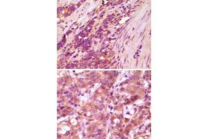 Immunohistochemical analysis of paraffin-embedded human stomach carcinoma (upper) and breast carcinoma (bottom) , showing cytoplasmic localization using FBLN5 monoclonal antibody, clone 3F10A5  with DAB staining.