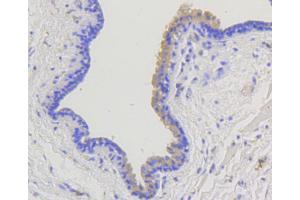 Immunohistochemistry of paraffin-embedded human mammary cancer using ARRB1 antibody (ABIN4903044) at dilution of 1:100 (40x lens).