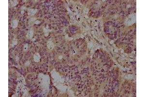 IHC image of ABIN7140157 diluted at 1:100 and staining in paraffin-embedded human colon cancer performed on a Leica BondTM system. (ST5 antibody  (AA 68-88))