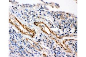 IHC-P: IKKb antibody testing of human lung cancer tissue (IKBKB antibody  (AA 398-756))