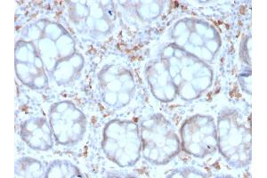 Formalin-fixed, paraffin-embedded human Colon Carcinoma stained with CD209 Mouse Monoclonal Antibody (rC209/1781).