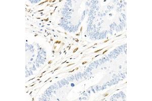 Immunohistochemistry of paraffin-embedded human colon carcinoma using QKI Rabbit mAb (ABIN7269699) at dilution of 1:1000 (40x lens). (QKI antibody)