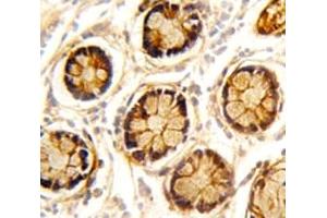 IHC analysis of FFPE human colon carcinoma stained with PDGFRL antibody (PDGFRL antibody  (AA 328-357))