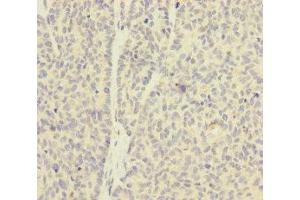 Immunohistochemistry of paraffin-embedded human ovarian cancer using ABIN7154941 at dilution of 1:100 (SKIV2L antibody  (AA 1-140))