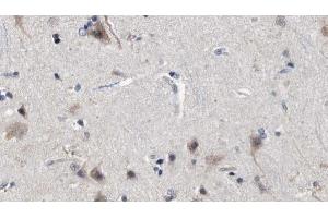 ABIN6272850 at 1/100 staining Human brain cancer tissue by IHC-P. (MFF antibody  (Internal Region))