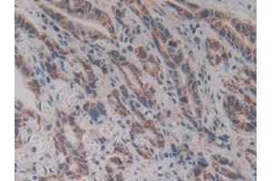 Detection of VNN1 in Human Stomach cancer Tissue using Polyclonal Antibody to Vanin 1 (VNN1) (VNN1 antibody  (AA 36-223))