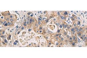 Immunohistochemistry of paraffin-embedded Human liver cancer tissue using DMRTA2 Polyclonal Antibody at dilution of 1:50(x200) (DMRTA2 antibody)