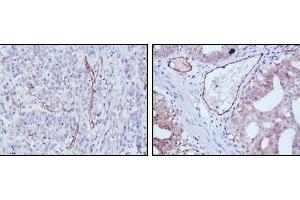 Immunohistochemical analysis of paraffin-embedded human stomach cancer (left) and ovary cancer (right) tissues using eNOS mouse mAb with DAB staining. (ENOS antibody)