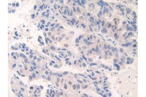 DAB staining on IHC-P; Samples: Human Breast cancer Tissue (CENPI antibody  (AA 292-528))