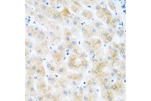 Immunohistochemistry of paraffin-embedded human liver cancer using DHODH antibody. (DHODH antibody  (AA 116-395))