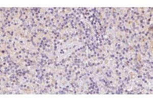 ABIN6273086 at 1/100 staining Human lymph cancer tissue by IHC-P. (VPS16 antibody  (Internal Region))