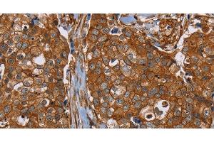 Immunohistochemistry of paraffin-embedded Human breast cancer tissue using PLEC Polyclonal Antibody at dilution 1:40 (PLEC antibody)