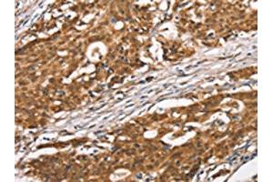 The image on the left is immunohistochemistry of paraffin-embedded Human gastric cancer tissue using ABIN7190465(DGAT1 Antibody) at dilution 1/40, on the right is treated with synthetic peptide. (DGAT1 antibody)