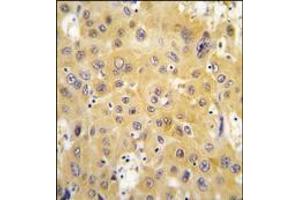 Formalin-fixed and paraffin-embedded human hepatocarcinoma tissue reacted with ECGF1 antibody (Center), which was peroxidase-conjugated to the secondary antibody, followed by DAB staining.