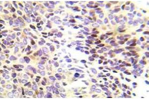 Immunohistochemistry (IHC) analyzes of CHK1 pAb in paraffin-embedded human lung adenocarcinoma tissue. (CHEK1 antibody)