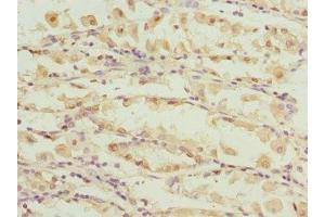 Immunohistochemistry of paraffin-embedded human gastric cancer using ABIN7146516 at dilution of 1:100 (Calpain S1 antibody  (AA 69-268))