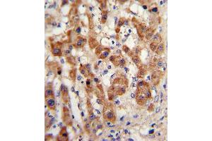 Formalin-fixed and paraffin-embedded human hepatocarcinoma with NAT2 Antibody (C-term), which was peroxidase-conjugated to the secondary antibody, followed by DAB staining. (NAT2 antibody  (C-Term))