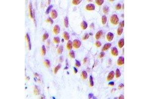 Immunohistochemical analysis of FOG2 staining in human breast cancer formalin fixed paraffin embedded tissue section. (ZFPM2 antibody)