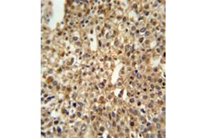 Formalin fixed and paraffin embedded human cervix carcinoma reacted with DENND1A Antibody (C-term) followed by peroxidase conjugation of the secondary antibody and DAB staining. (DENND1A antibody  (C-Term))