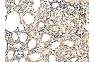 The image on the left is immunohistochemistry of paraffin-embedded Human thyroid cancer tissue using ABIN7192947(TSPYL6 Antibody) at dilution 1/20, on the right is treated with synthetic peptide. (TSPY-Like 6 antibody)