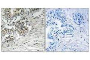 Immunohistochemistry analysis of paraffin-embedded human prostate carcinoma tissue using Claudin 7 (Ab-210) antibody.