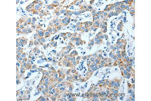 Immunohistochemistry of Human breast cancer using ALDH4A1 Polyclonal Antibody at dilution of 1:35 (ALDH4A1 antibody)