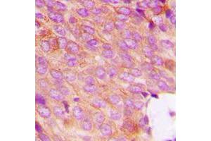 Immunohistochemical analysis of DOK2 (pY299) staining in human breast cancer formalin fixed paraffin embedded tissue section. (DOK2 antibody  (pTyr299))