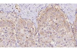 ABIN6273328 at 1/100 staining Human thyroid cancer tissue by IHC-P. (TBC1D23 antibody  (Internal Region))