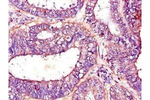 Immunohistochemistry of paraffin-embedded human endometrial cancer using ABIN7144954 at dilution of 1:100 (PFKM antibody  (AA 166-334))