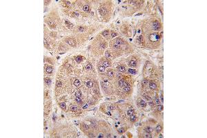 Formalin-fixed and paraffin-embedded human hepatocarcinoma tissue reacted with PIM3 antibody (C-term) (ABIN391253 and ABIN2841313) , which was peroxidase-conjugated to the secondary antibody, followed by DAB staining. (PIM3 antibody  (C-Term))